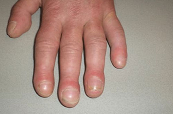 Ung thư phổi giai đoạn đầu có thể dẫn đến tình trạng ngón tay dùi trống